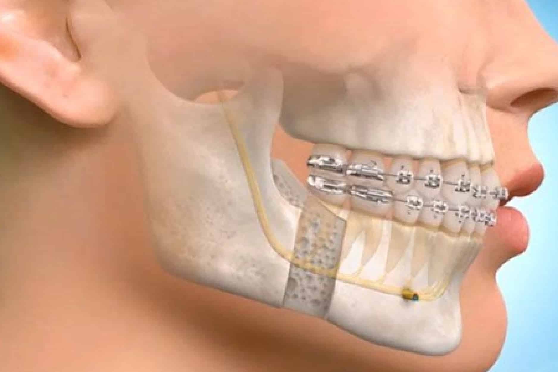 Maxillofacial surgery